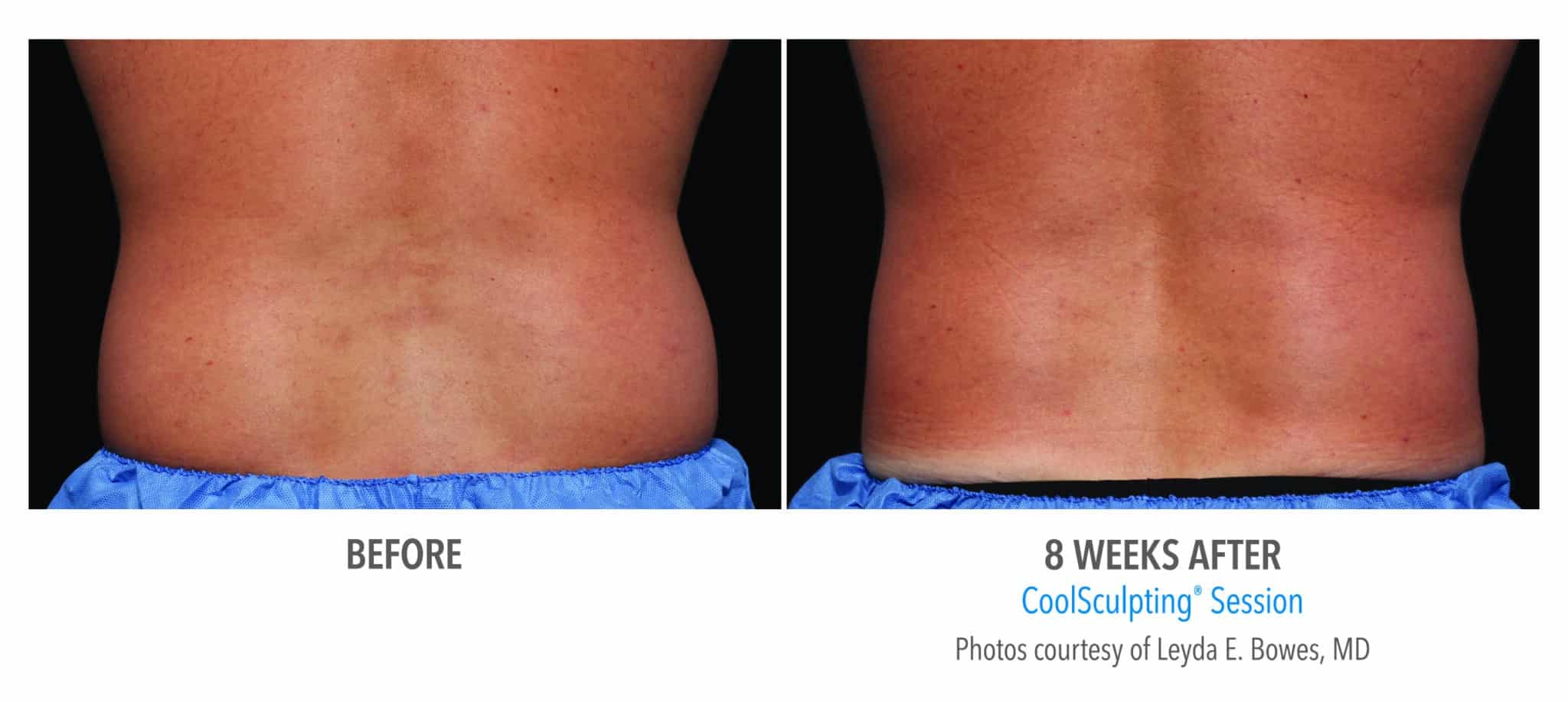CoolSculpting Grand Rapids mi | Elite Plastic Surgery CoolSculpting Grand Rapids mi | Elite Plastic Surgery