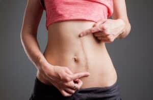 Close-up of a woman pointing to a vertical scar on her abdomen, illustrating a common area treated with scar revision surgery