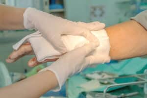 Doctor bandaging burn injury on person’s hand