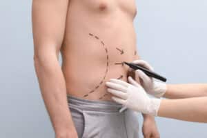 Plastic surgeon marking up a man's midsection to prepare for liposuction