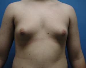 Gynecomastia Grand Rapids MI