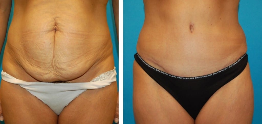 before and after photos of woman's stomach showing vast improvement in skin tightness after tummy tuck