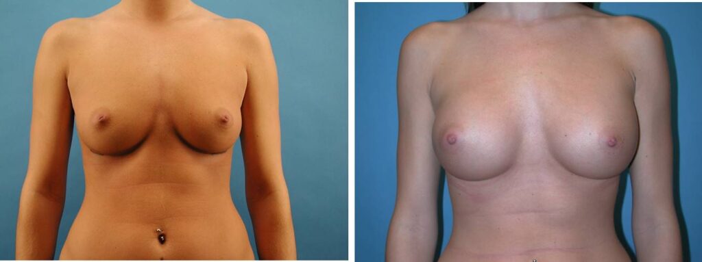 Breast Augmentation grand rapids michigan 