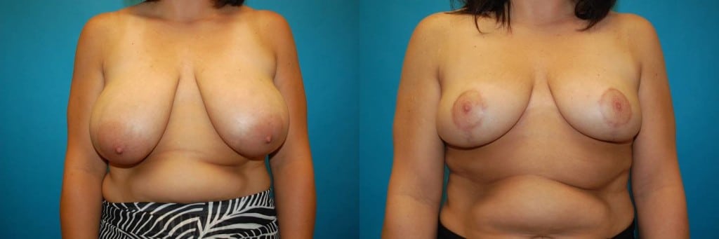 Breast Reduction Grand Rapids Michigan