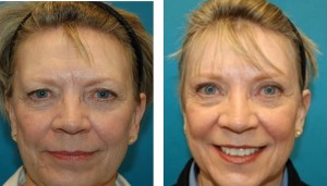 browlift grand rapids mi | forehead lift