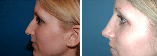 rhinoplasty before and after