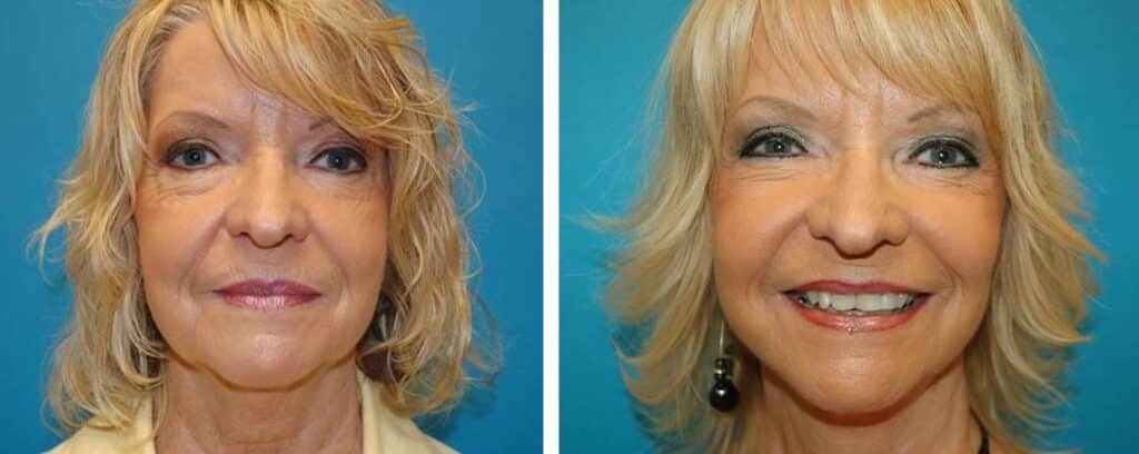 Facelift Before and After Photos Grand Rapids MI