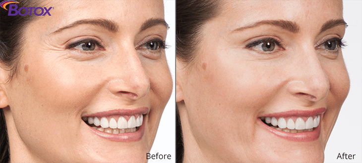 Botox | Botox Injections | Xeomin Grand Rapids