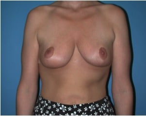 breast lift grand rapids | mastopexy