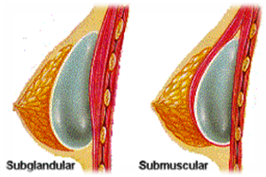 Breast Augmentation Grand Rapids MI | Byron Center MI