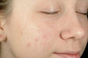 Patient # 69894 Before Photo # 1