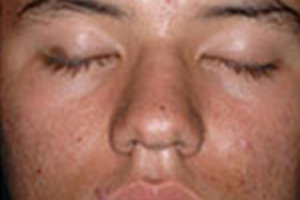 Patient # 85931 Before Photo # 1