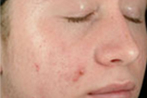 Patient # 85405 Before Photo # 1