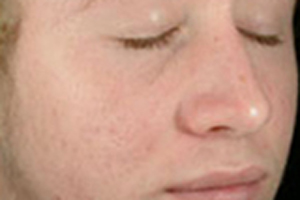 Patient # 85405 After Photo # 2