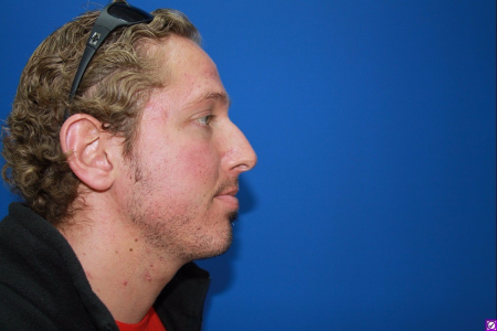 Patient # 12179 Before Photo # 3