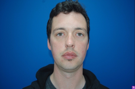 Patient # 28734 Before Photo # 1