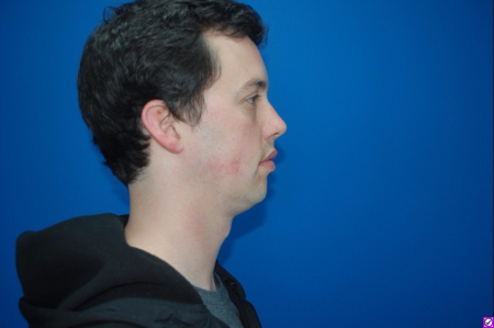 Patient # 28734 Before Photo # 3