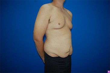 Patient # 42227 Before Photo # 3