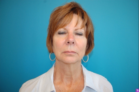 Patient # 82352 Before Photo # 1