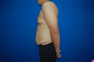 Patient # 42227 Before Photo # 5