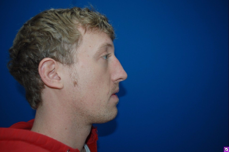 Patient # 92662 Before Photo # 3