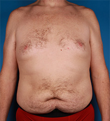 Patient # 81504 Before Photo # 1