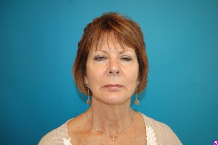 Patient # 82352 After Photo # 2