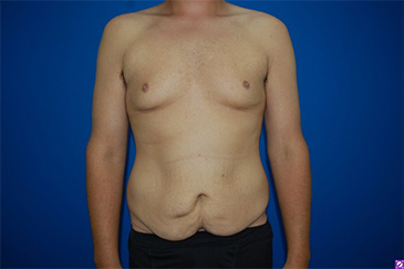 Patient # 42227 Before Photo # 1