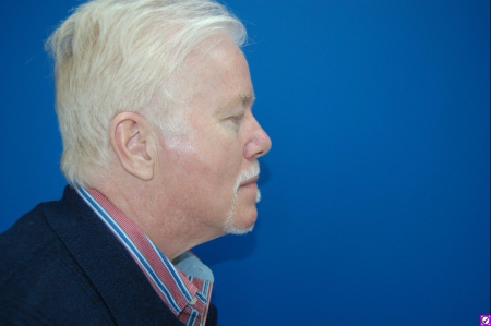 Patient # 61495 After Photo # 4