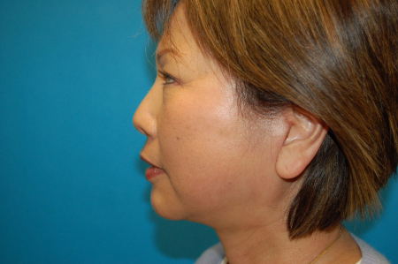 Patient # 67553 After Photo # 4