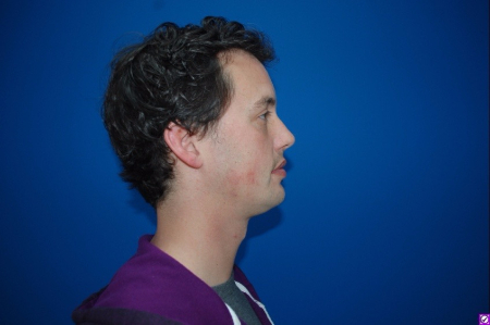 Patient # 28734 After Photo # 4