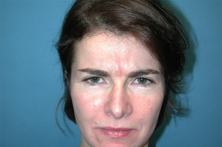 Patient # 49067 Before Photo # 1