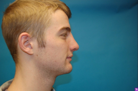 Patient # 60844 After Photo # 4