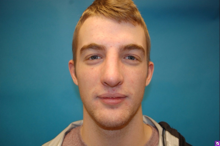 Patient # 60844 After Photo # 2