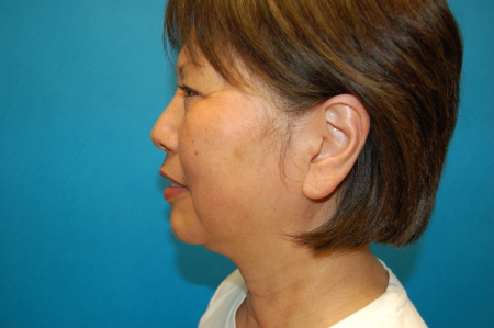 Patient # 67553 Before Photo # 3