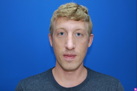 Patient # 92662 After Photo # 2