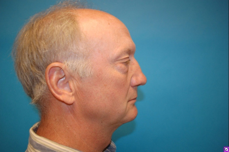 Patient # 54966 After Photo # 2