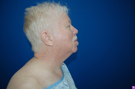 Patient # 61495 Before Photo # 3