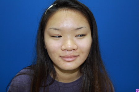 Patient # 69257 Before Photo # 1