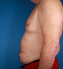 Patient # 81504 Before Photo # 5