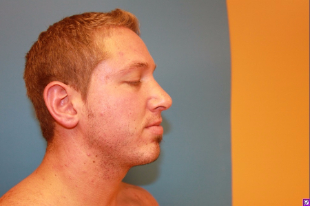 Patient # 12179 After Photo # 4