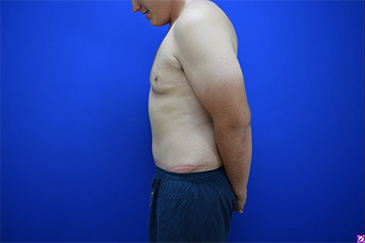 Patient # 42227 After Photo # 6