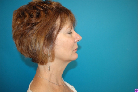 Patient # 82352 After Photo # 4