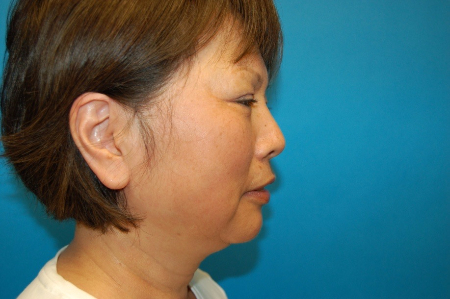 Patient # 67553 Before Photo # 5