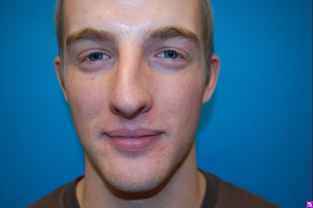 Patient # 60844 Before Photo # 1