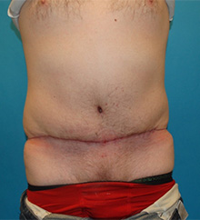 Patient # 81504 After Photo # 2