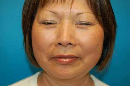 Patient # 67553 Before Photo # 1