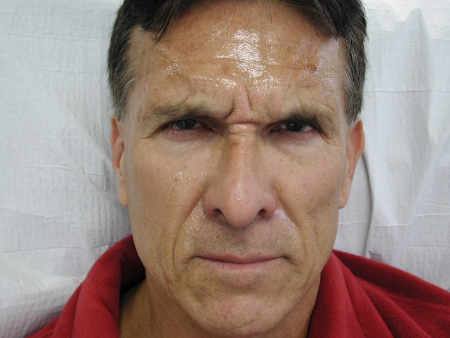 Patient # 70294 Before Photo # 3