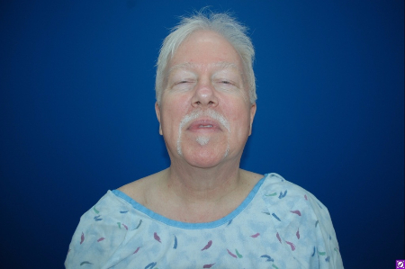 Patient # 61495 Before Photo # 1