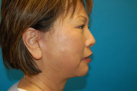 Patient # 67553 After Photo # 6